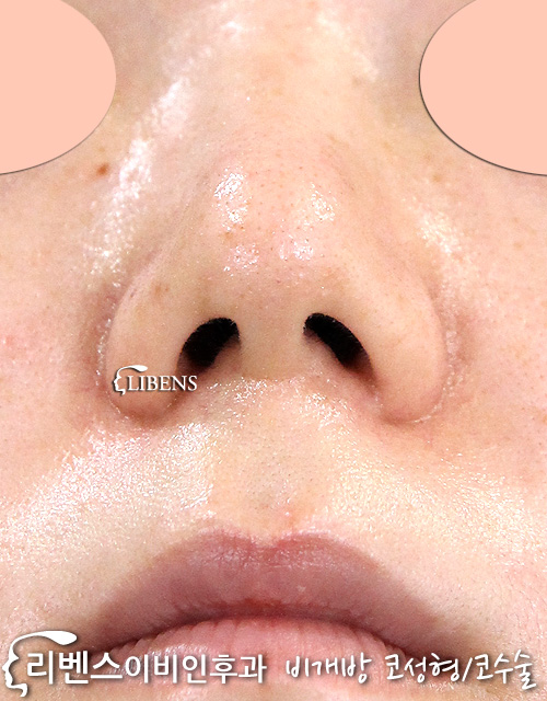 무보형물 매부리코 메부리코 코끝 성형 수술 교정 절골 비염 성형 s629